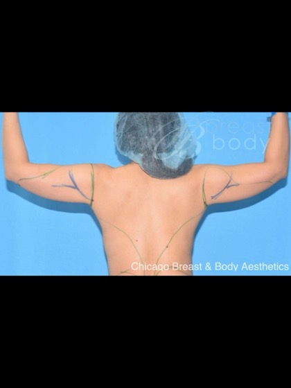 Arm liposuction before photo, back view, Case 1780466