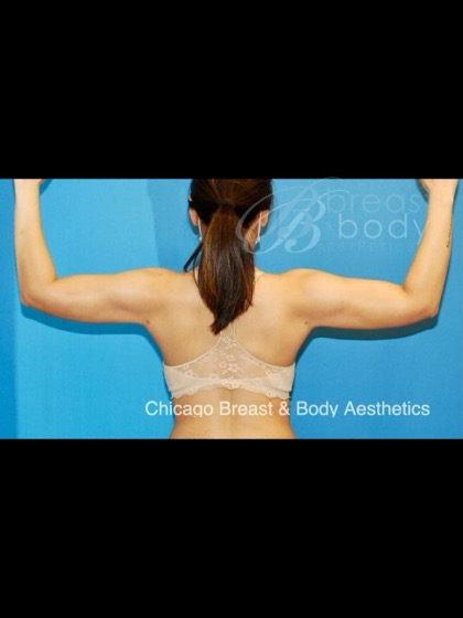 Arm liposuction after photo, back view, Case 1780466