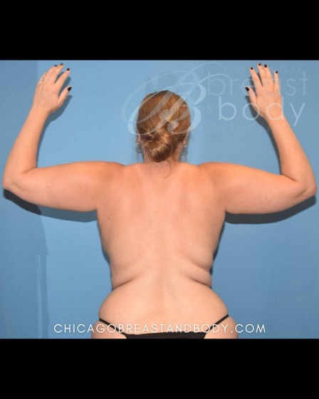 Arm liposuction before photo, back view, Case 19104960