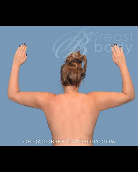 Arm liposuction after photo, back view, Case 19104960