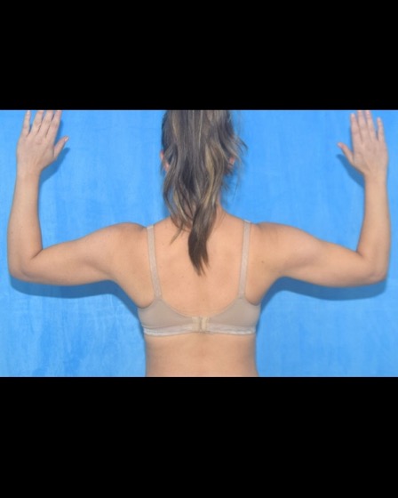 Arm liposuction after photo, back view, Case 2006202