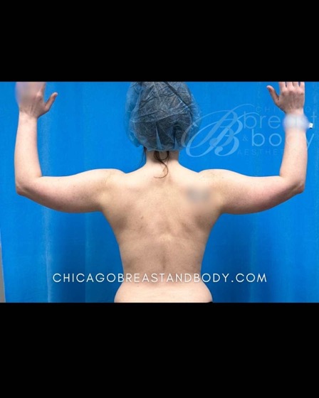 Arm liposuction before photo, back view, Case 2360167
