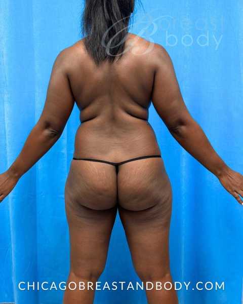 Brazilian Butt Lift, Hip Augmentation & Lipo 360 before photo, actual patient, Case 2297957