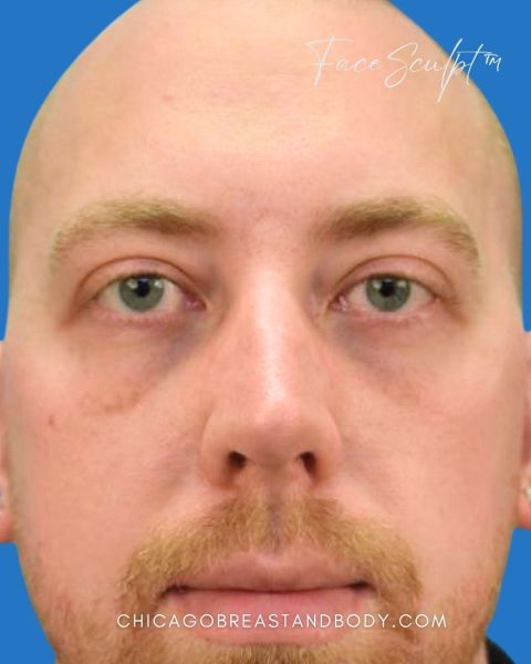 Eyelid surgery after photo, front view, Case 1001241