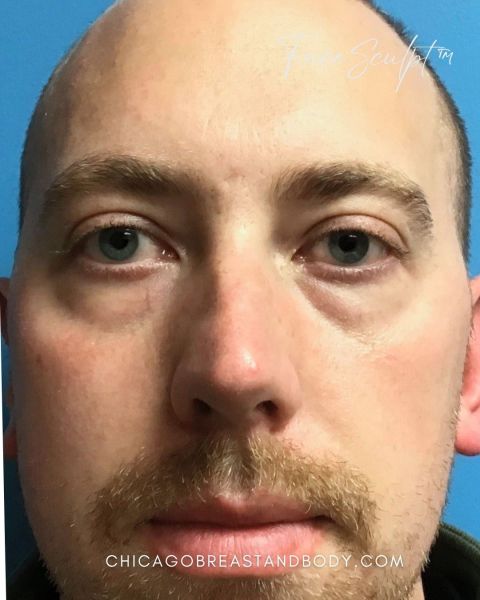 Eyelid surgery before photo, front view, Case 1001241