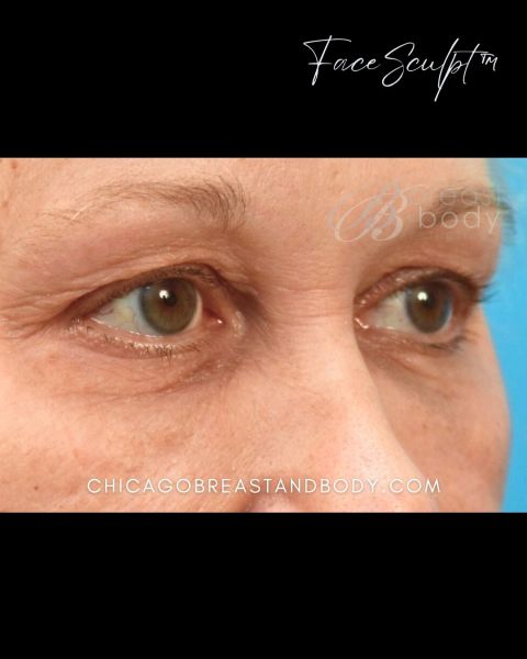 Eyelid surgery after photo, front view, Case 1001243