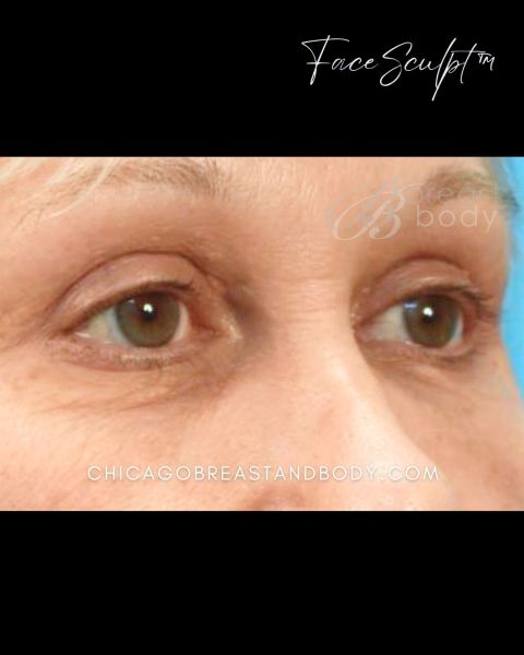 Eyelid surgery before photo, front view, Case 1001243