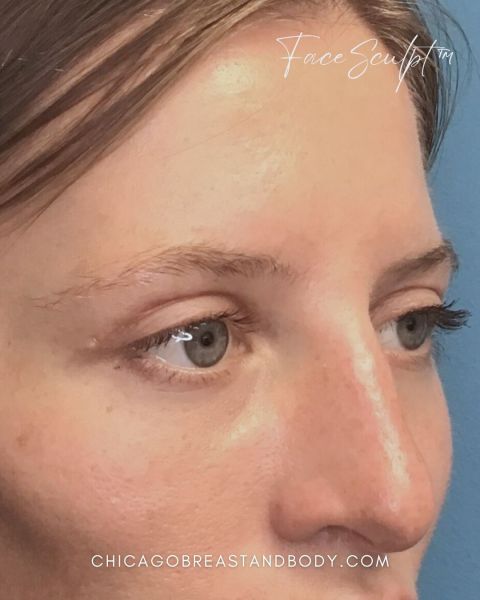 Eyelid surgery after photo, front view, Case 1001245