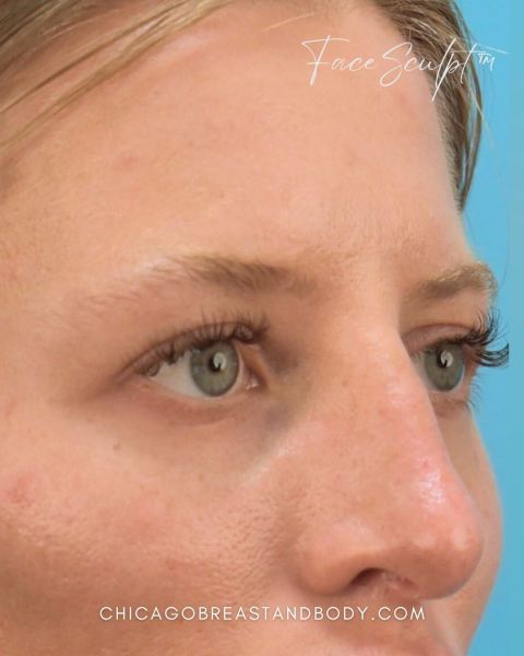 Eyelid surgery before photo, front view, Case 1001245