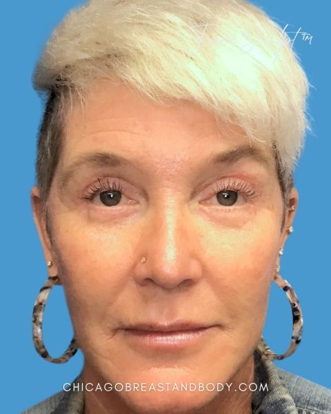 Eyelid surgery after photo, front view, Case 1021242