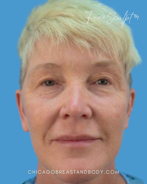 Eyelid surgery before photo, front view, Case 1021242