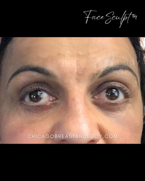 Eyelid surgery after photo, front view, Case 52654