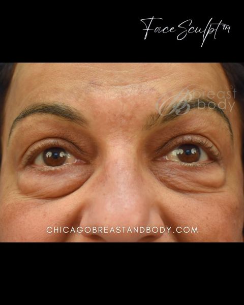Eyelid surgery before photo, front view, Case 52654