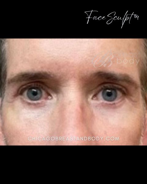 Eyelid surgery after photo, front view, Case 61351