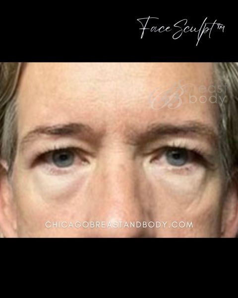 Eyelid surgery before photo, front view, Case 61351