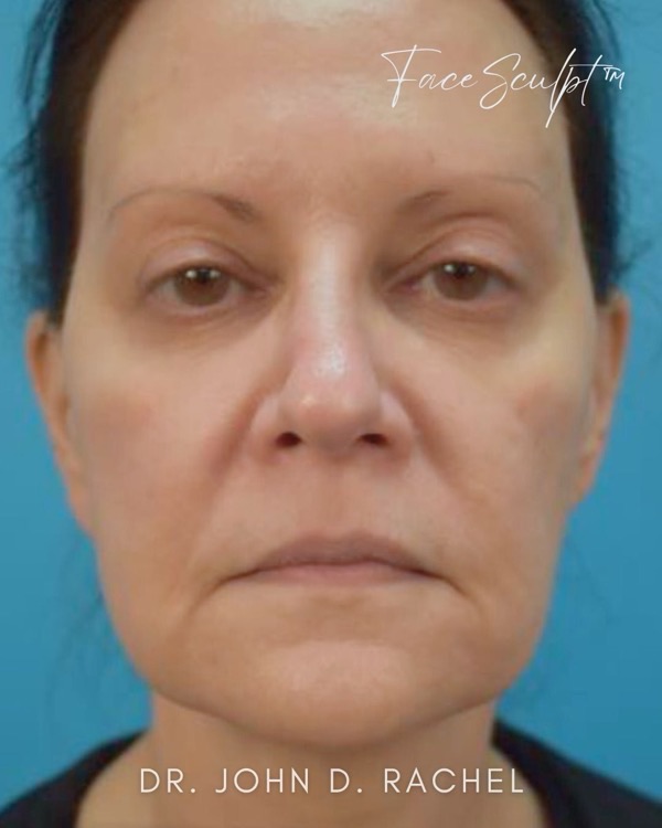 Patient before mini facelift surgery with Dr. Rachel