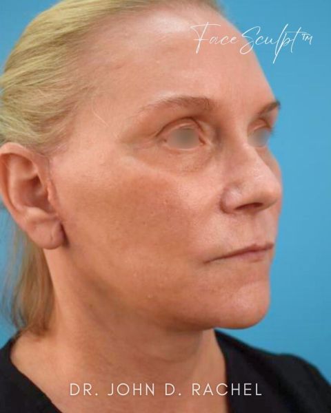 Facelift after photo, front view, Case 0104254