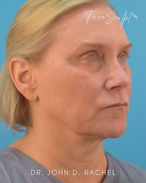 Facelift before photo, front view, Case 0104254