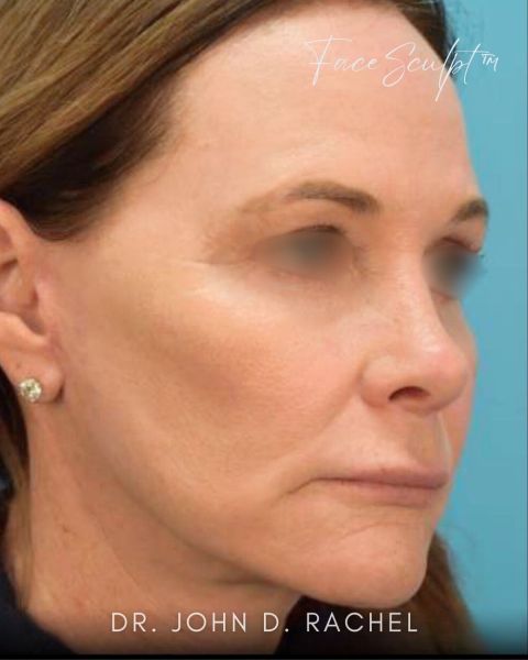 Facelift after photo, front view, Case 128245