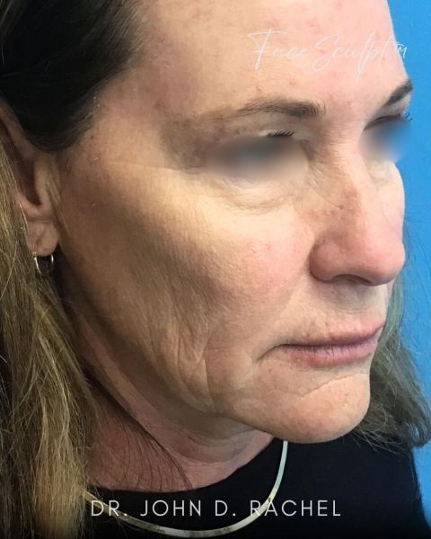 Facelift before photo, front view, Case 128245