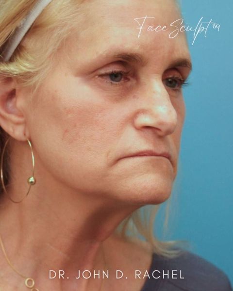 Facelift before photo, front view, Case 61352