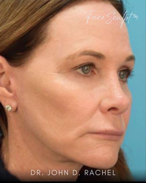 Facelift after photo, front view, Case 61355
