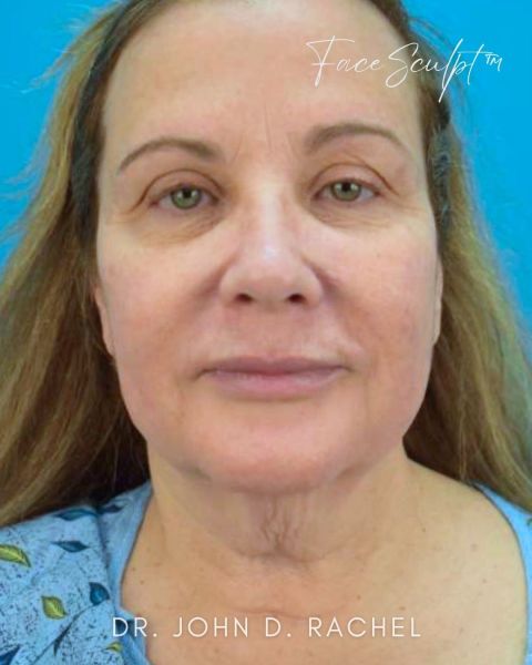Facelift before photo, front view, Case 61356