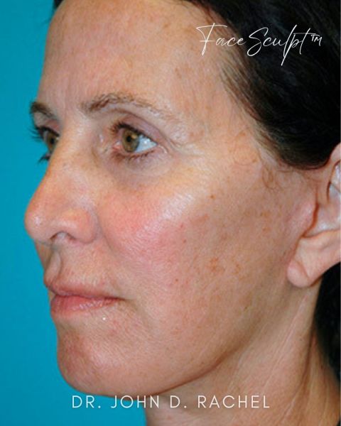 Facelift after photo, front view, Case 61359