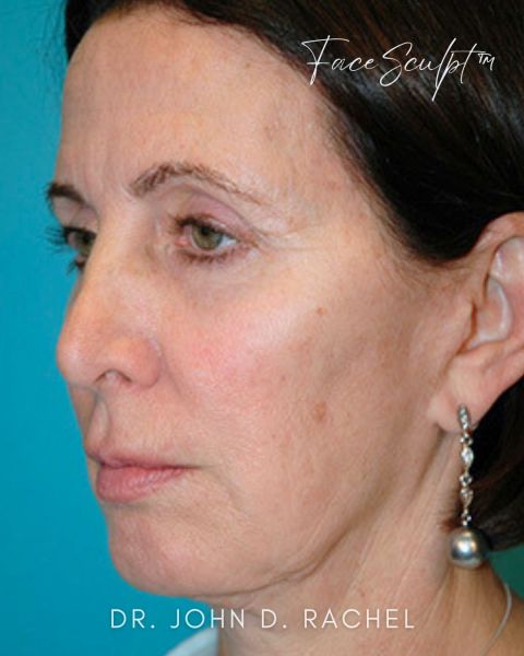 Facelift before photo, front view, Case 61359
