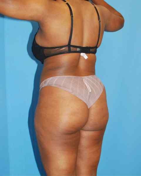 Lipo 360 & Brazilian Butt Lift before photo, actual patient, Case 1573322