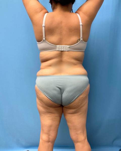 Lipo 360 & Liposuction before photo, actual patient, Case 1821713