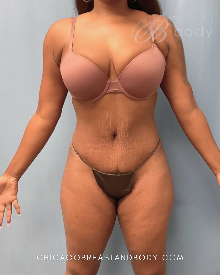 Actual Chicago Breast and Body Mommy Makeover patient, Dr. Lin, 3 months post-op