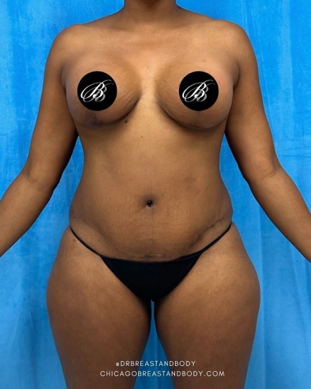 Actual Chicago Breast and Body Mommy Makeover patient, 2 months post-op