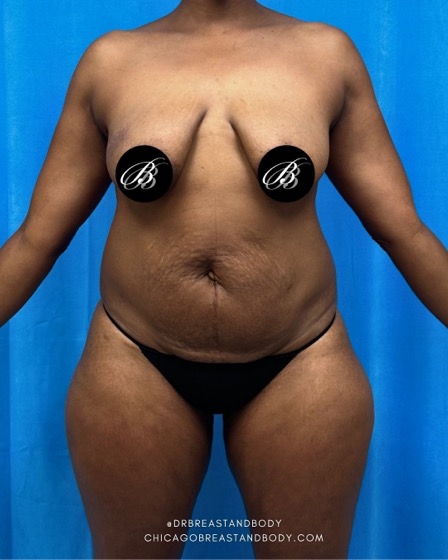Mommy Makeover before photo, front view, Case 2294674