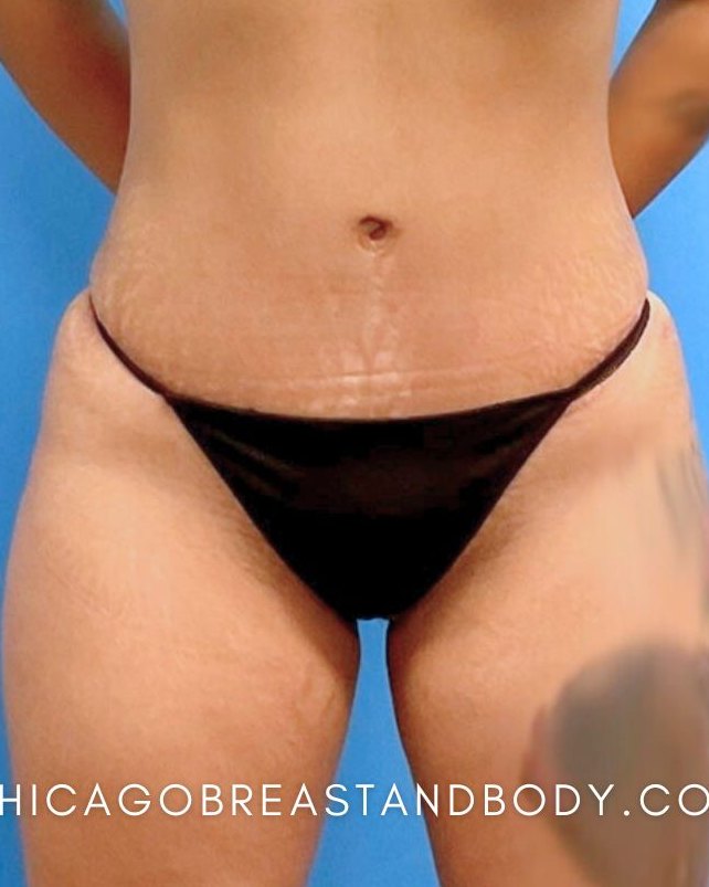 Mommy Makeover after photo, abdomen detail, Case 36328