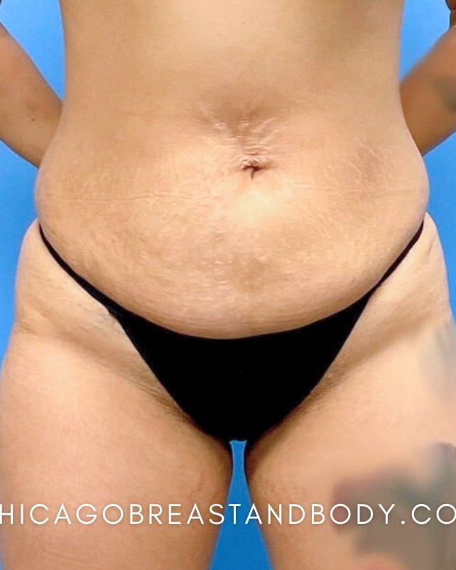 Mommy Makeover before photo, abdomen detail, Case 36328