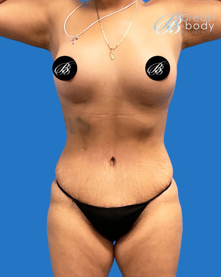 Mommy Makeover after photo, front view, Dr. Lin patient