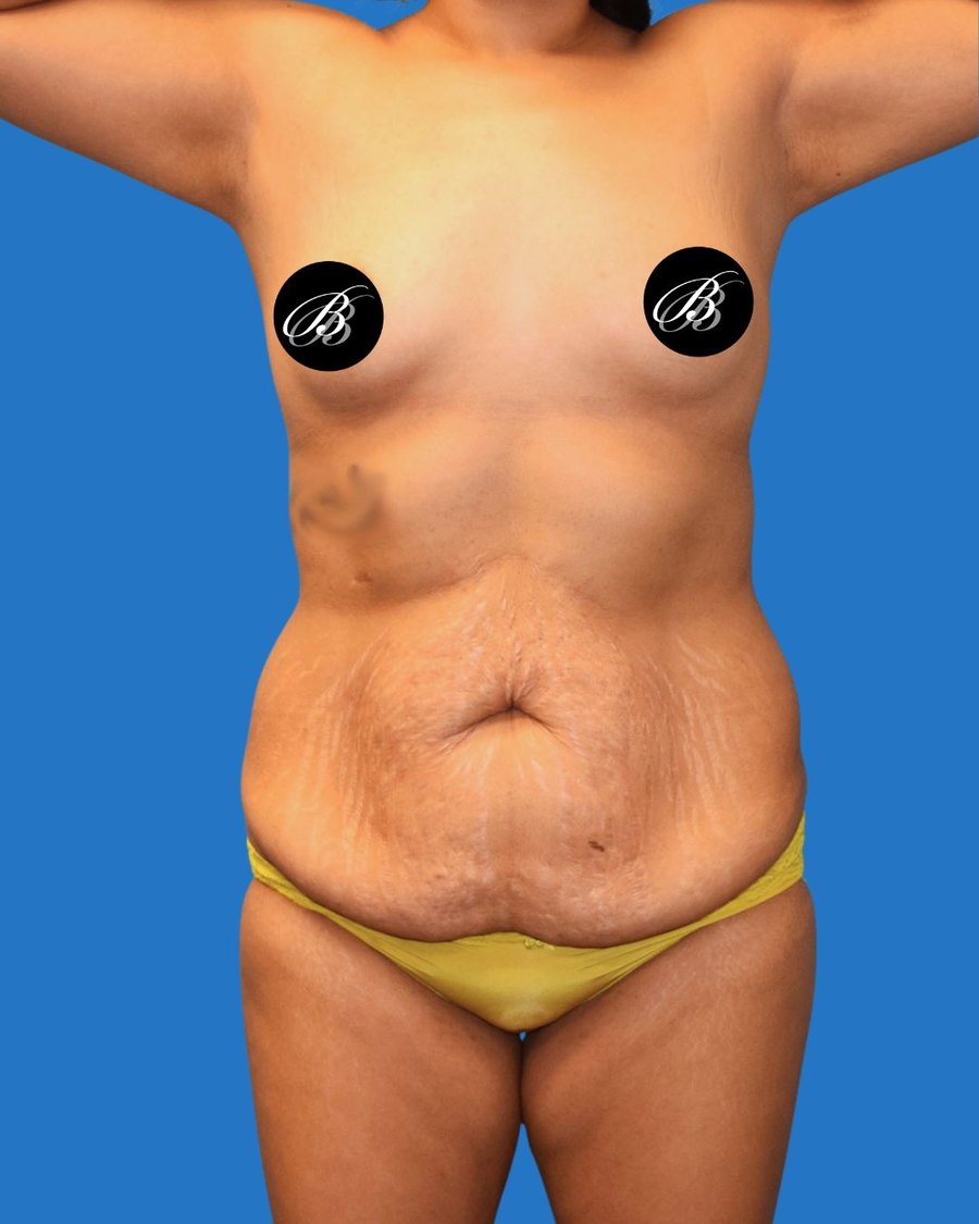 Mommy Makeover before photo, front view, Dr. Lin patient