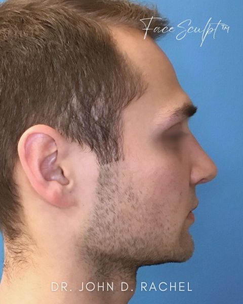 Rhinoplasty after photo, front view, Case 1029241