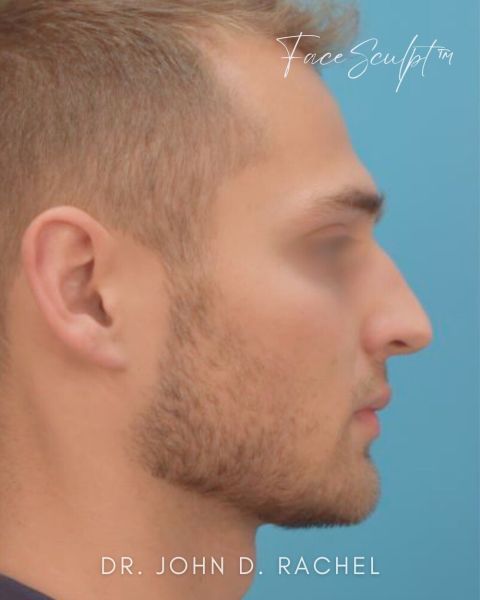 Rhinoplasty before photo, front view, Case 1029241
