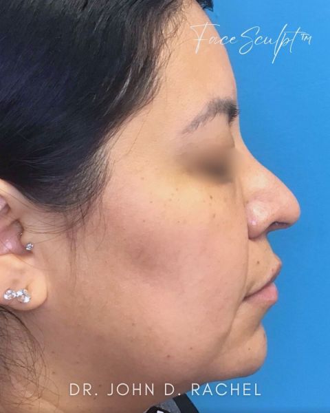 Rhinoplasty after photo, front view, Case 1111241