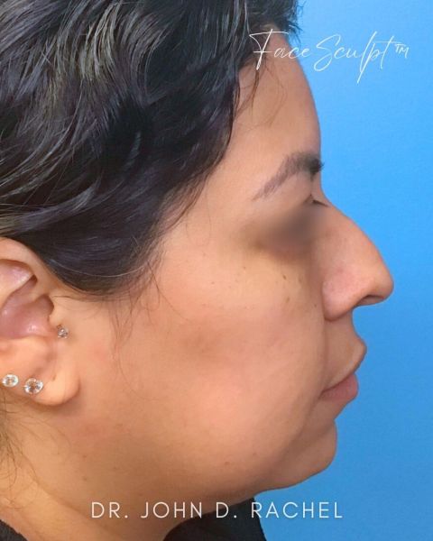 Rhinoplasty before photo, front view, Case 1111241
