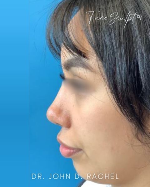 Rhinoplasty after photo, front view, Case 1111243