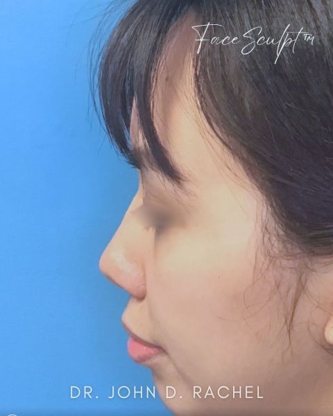 Rhinoplasty before photo, front view, Case 1111243