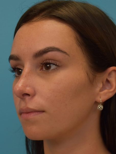 Rhinoplasty after photo, front view, Case 4423