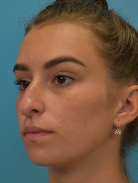 Rhinoplasty before photo, front view, Case 4423