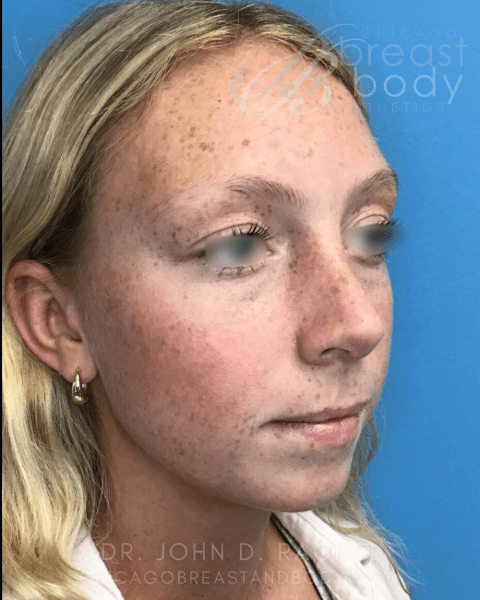 Rhinoplasty after photo, front view, Case 930241