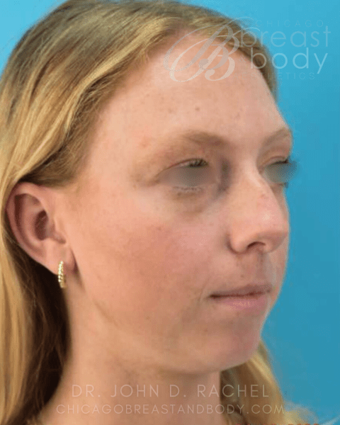 Rhinoplasty before photo, front view, Case 930241