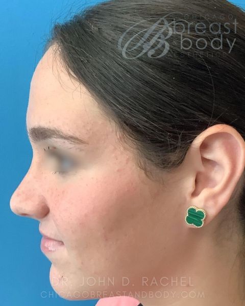 Rhinoplasty after photo, front view, Case 930244