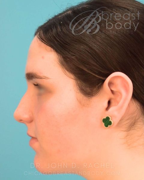 Rhinoplasty before photo, front view, Case 930244